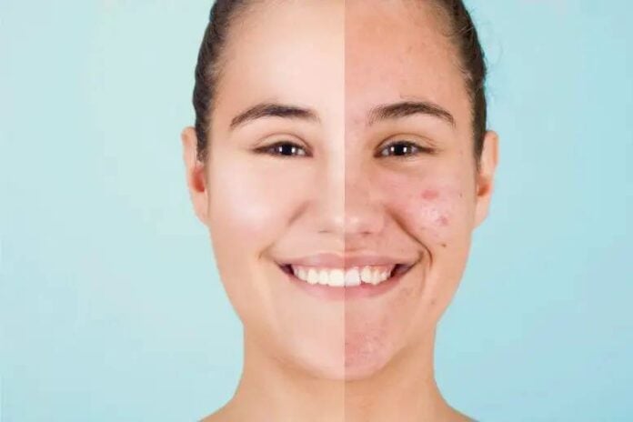 Nanotechnology to Combat Acne