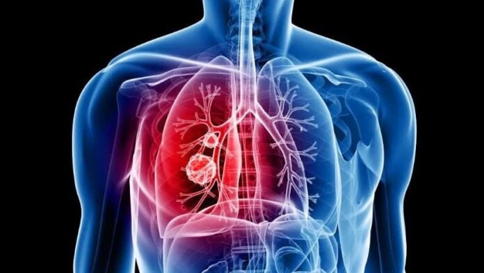 higher lung cancer in women