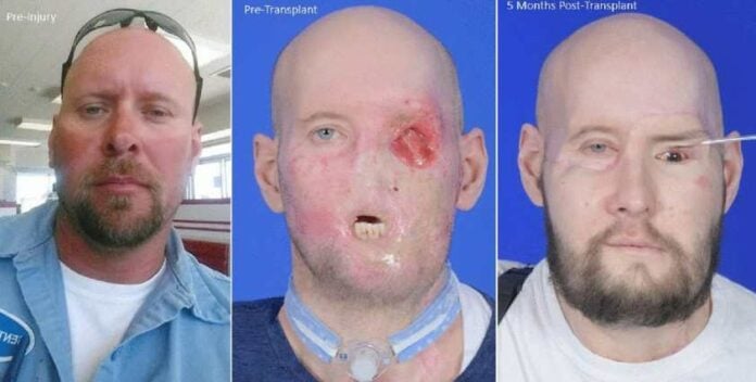 The World's First Whole-Eye Transplant