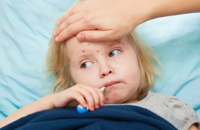 Measles