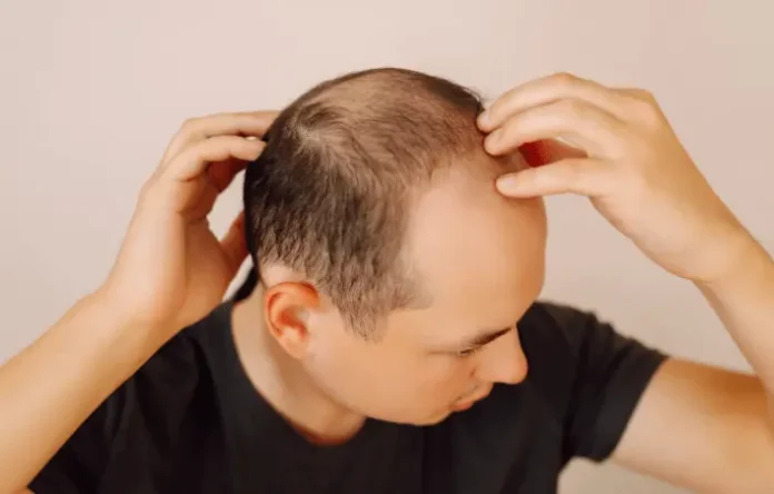 PP405 hair regrowth natural treatment for fuller and thicker hair